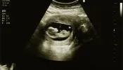 A sonogram picture of a fetus in the second trimester of a woman's pregnancy