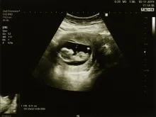 A sonogram picture of a fetus in the second trimester of a woman's pregnancy.
